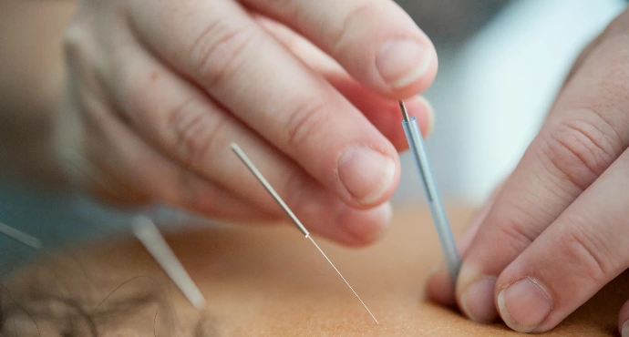 acupuncture needles inserted into skin